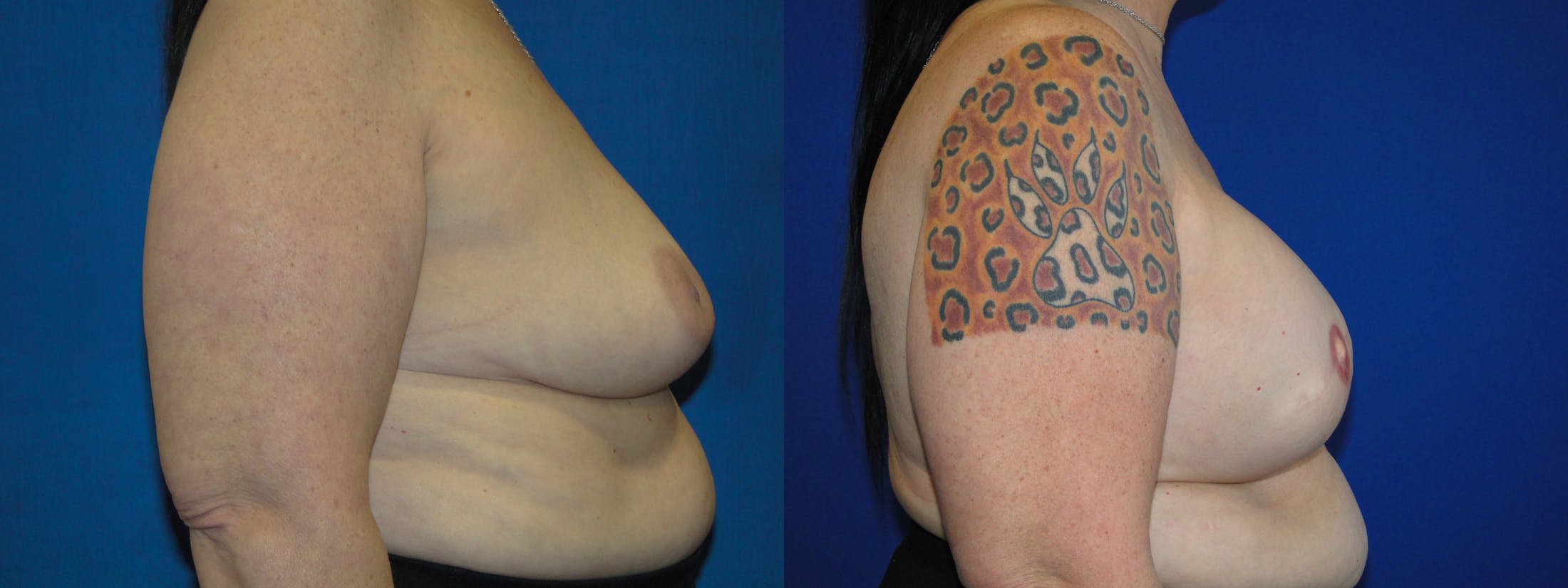 Breast Reconstruction Before & After Gallery - Patient 74827855 - Image 2