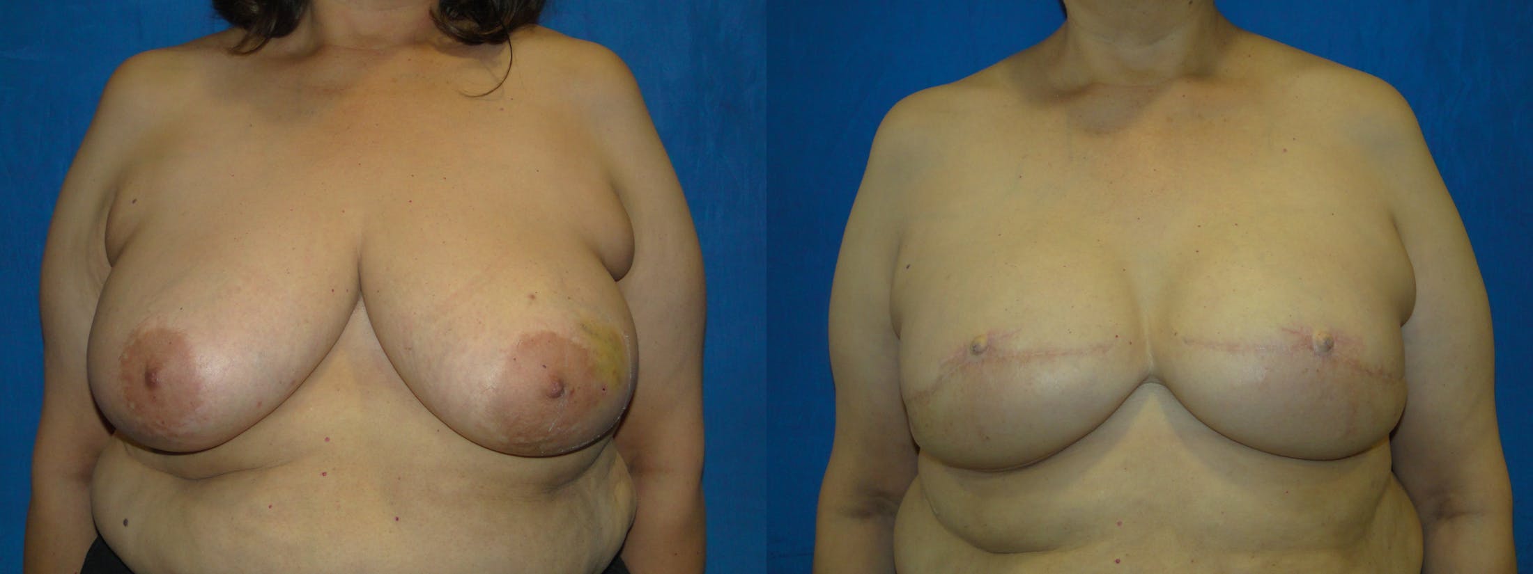 Breast Reconstruction Before & After Gallery - Patient 74827866 - Image 1