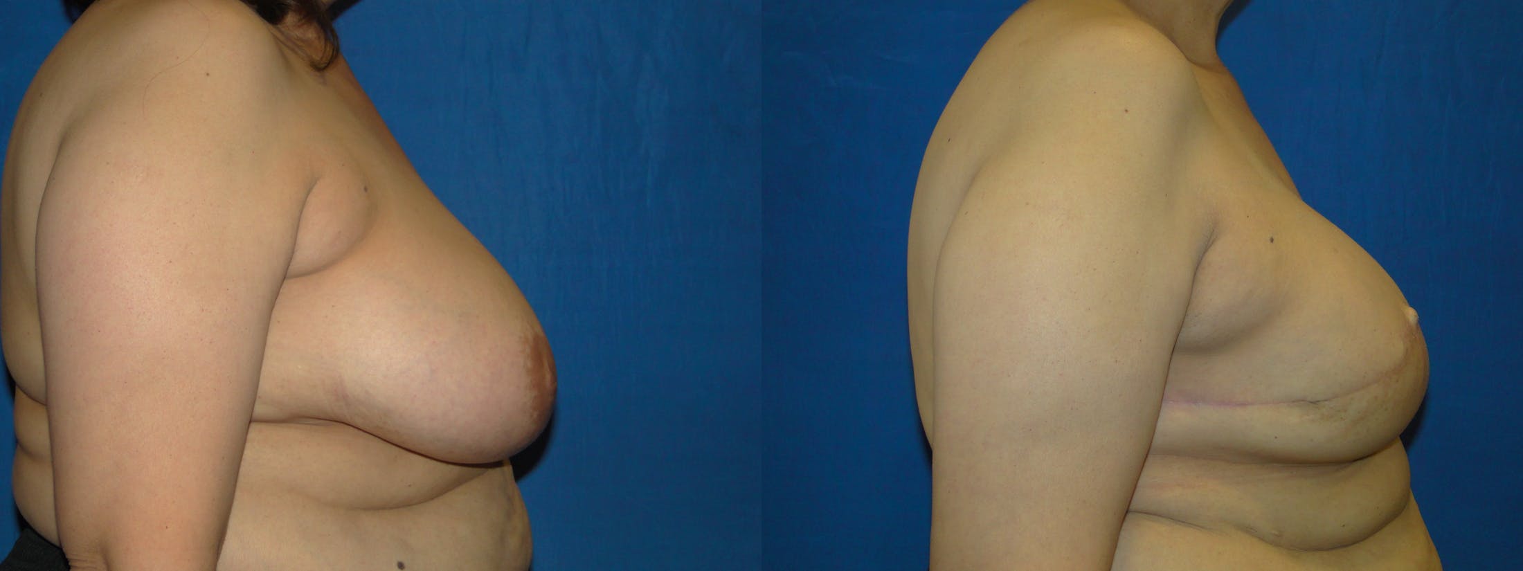 Breast Reconstruction Before & After Gallery - Patient 74827866 - Image 2