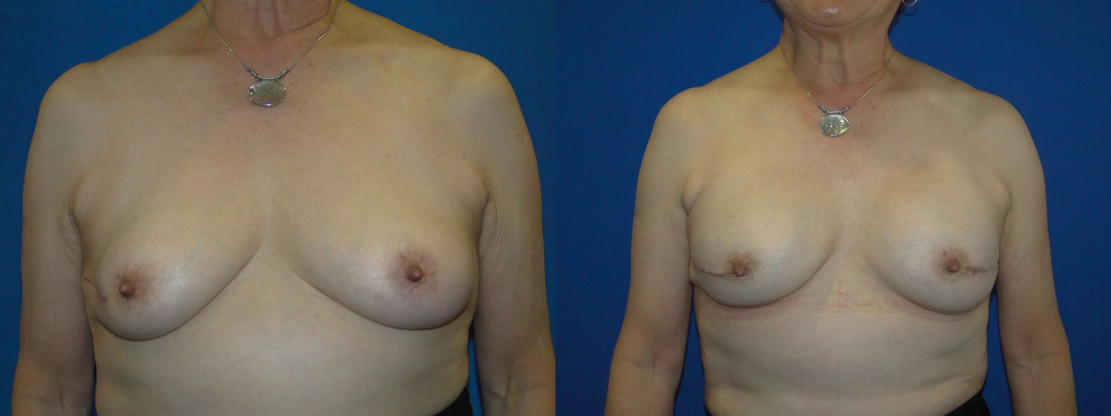 Breast Reconstruction Gallery - Patient 74853286 - Image 1