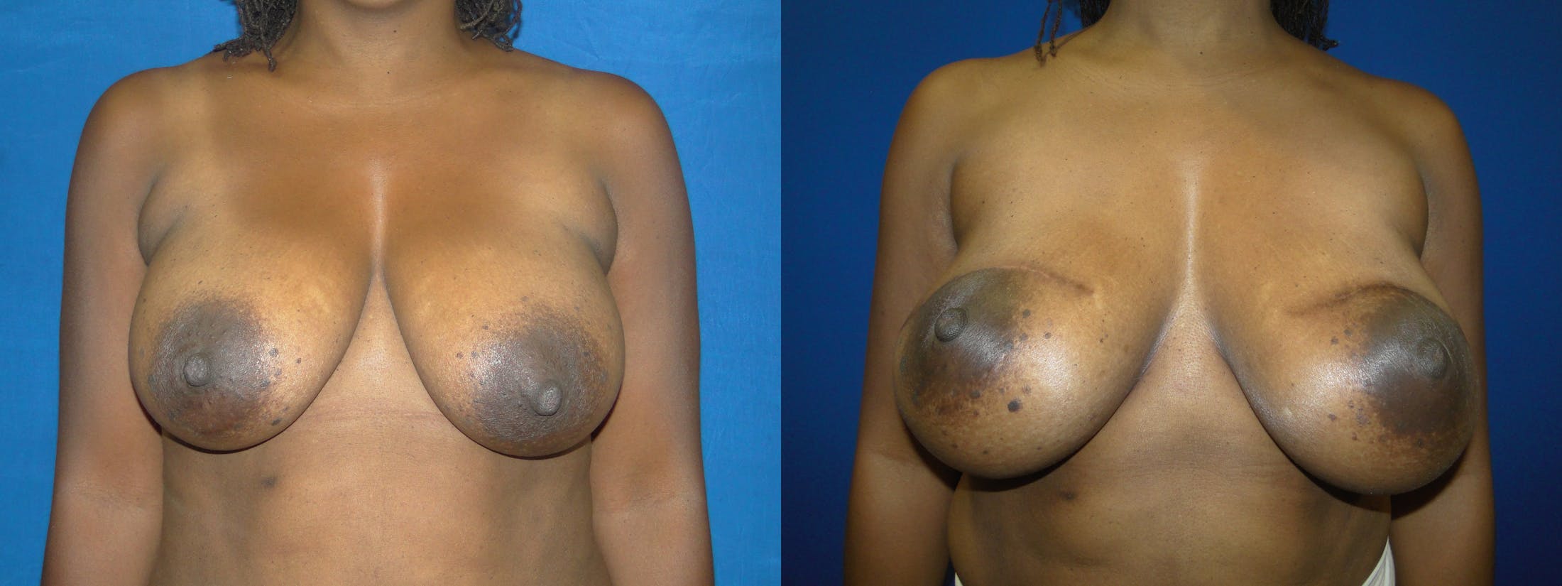 Breast Reconstruction Before & After Gallery - Patient 74853371 - Image 1