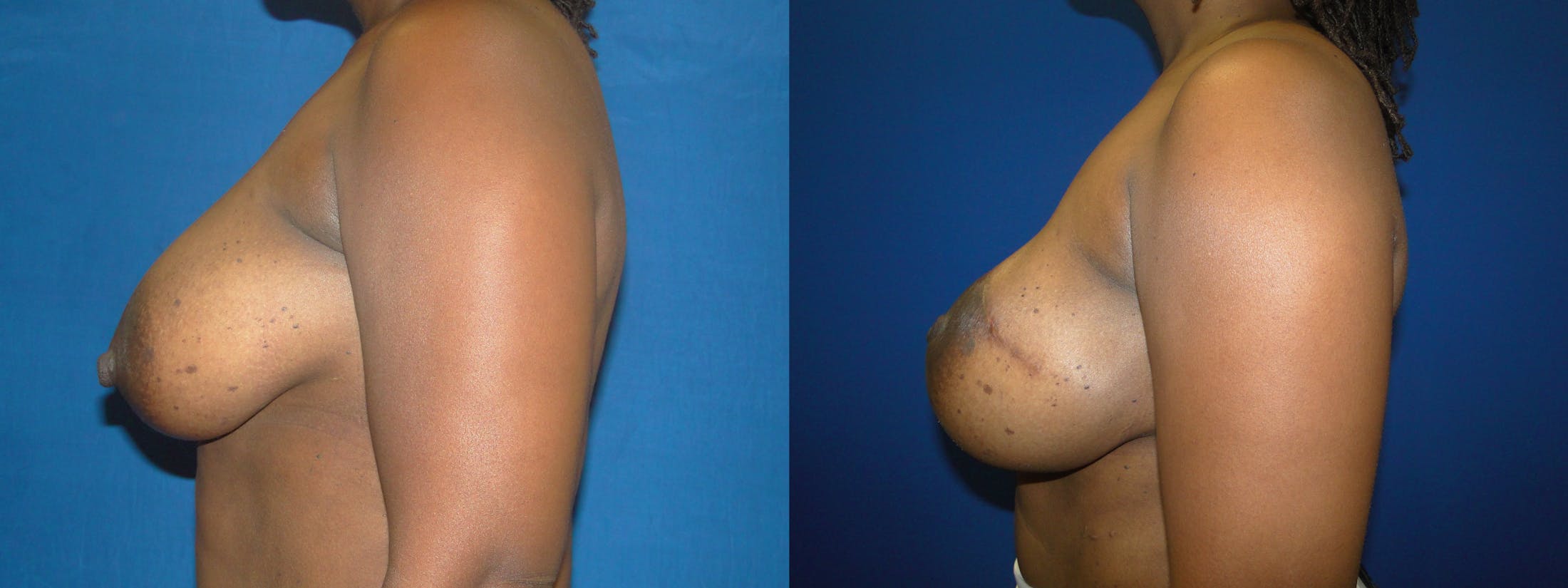 Breast Reconstruction Before & After Gallery - Patient 74853371 - Image 2