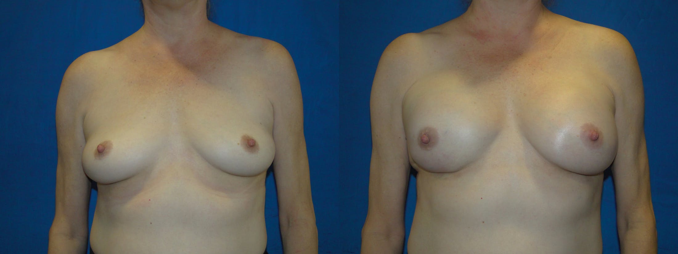 Breast Reconstruction Gallery - Patient 74853373 - Image 1
