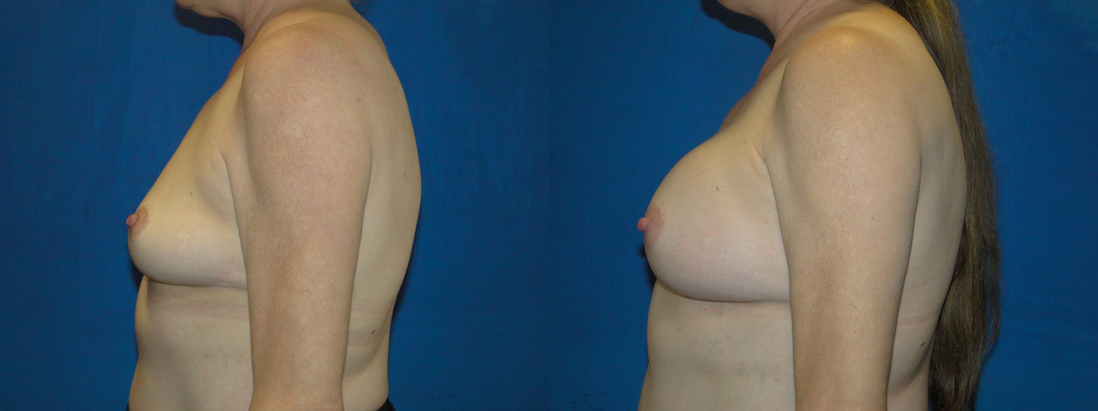 Breast Reconstruction Before & After Gallery - Patient 74853373 - Image 2
