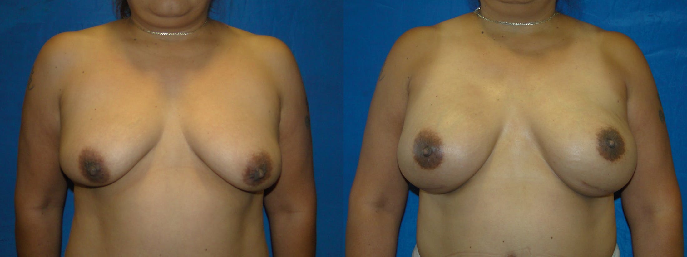 Breast Reconstruction Before & After Gallery - Patient 74853386 - Image 1
