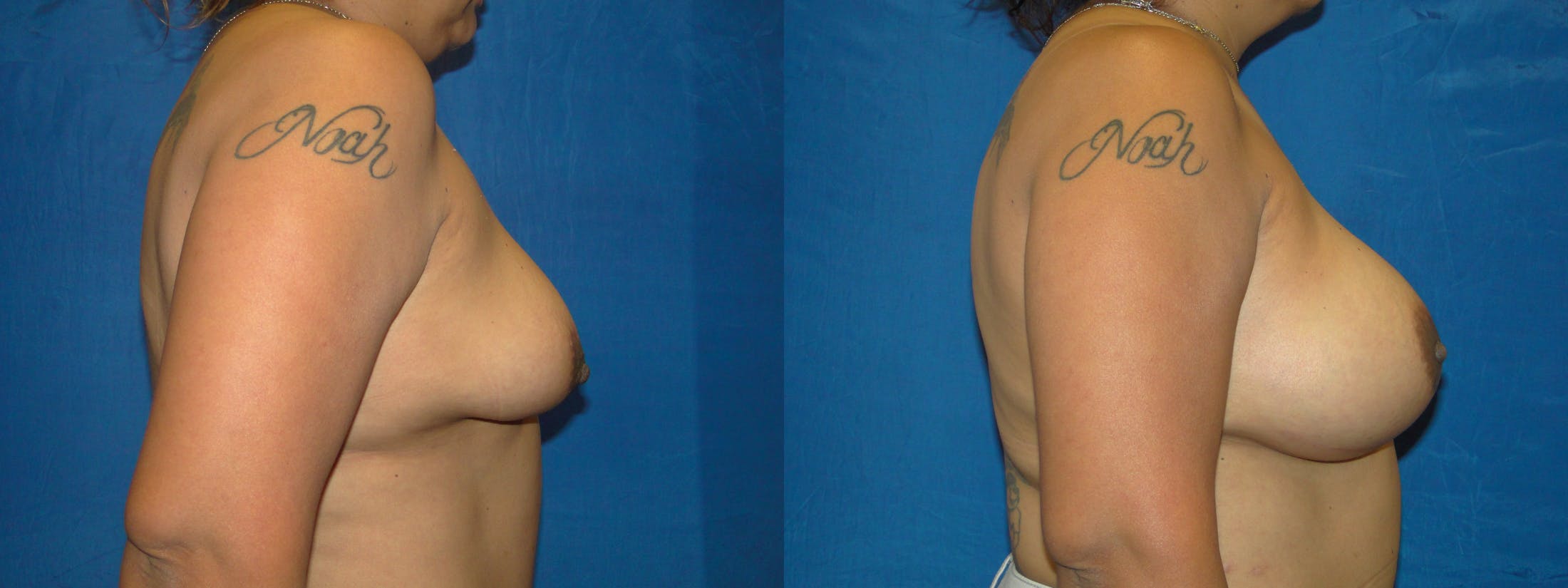 Breast Reconstruction Gallery - Patient 74853386 - Image 2