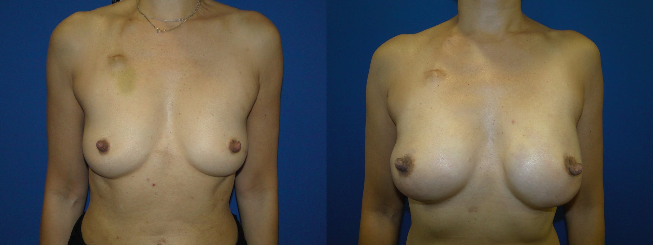 Breast Reconstruction Before & After Gallery - Patient 74853392 - Image 1