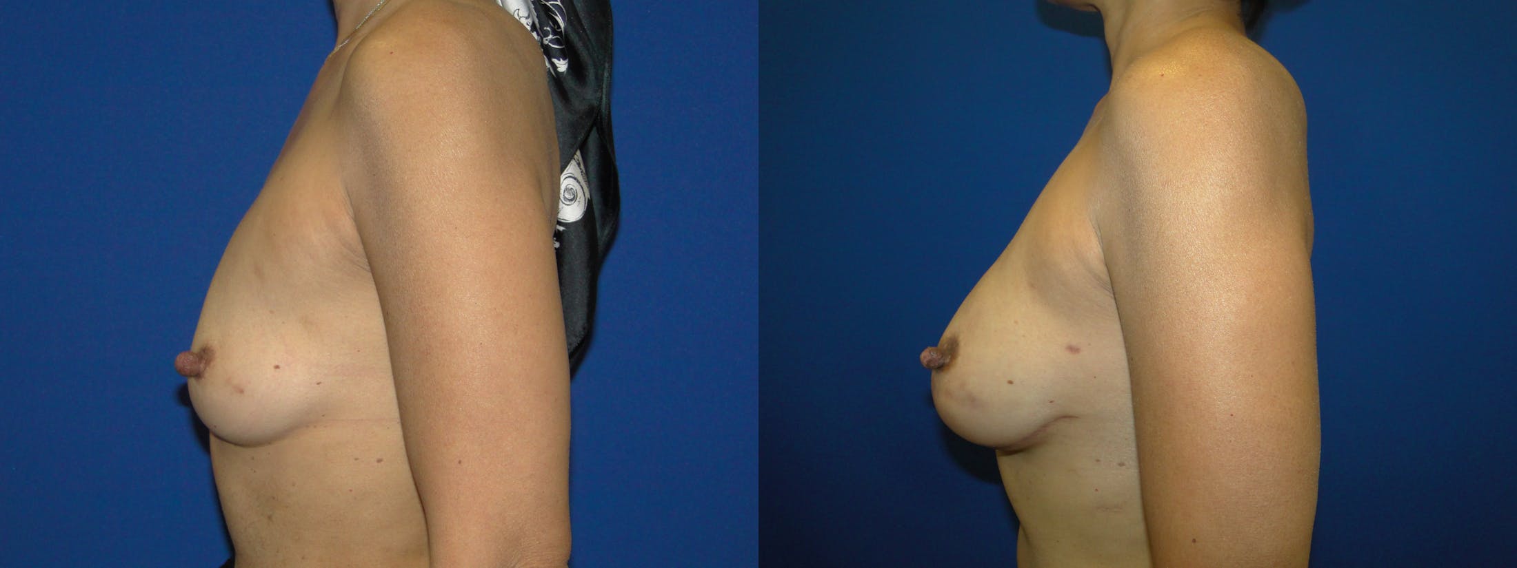 Breast Reconstruction Before & After Gallery - Patient 74853392 - Image 2