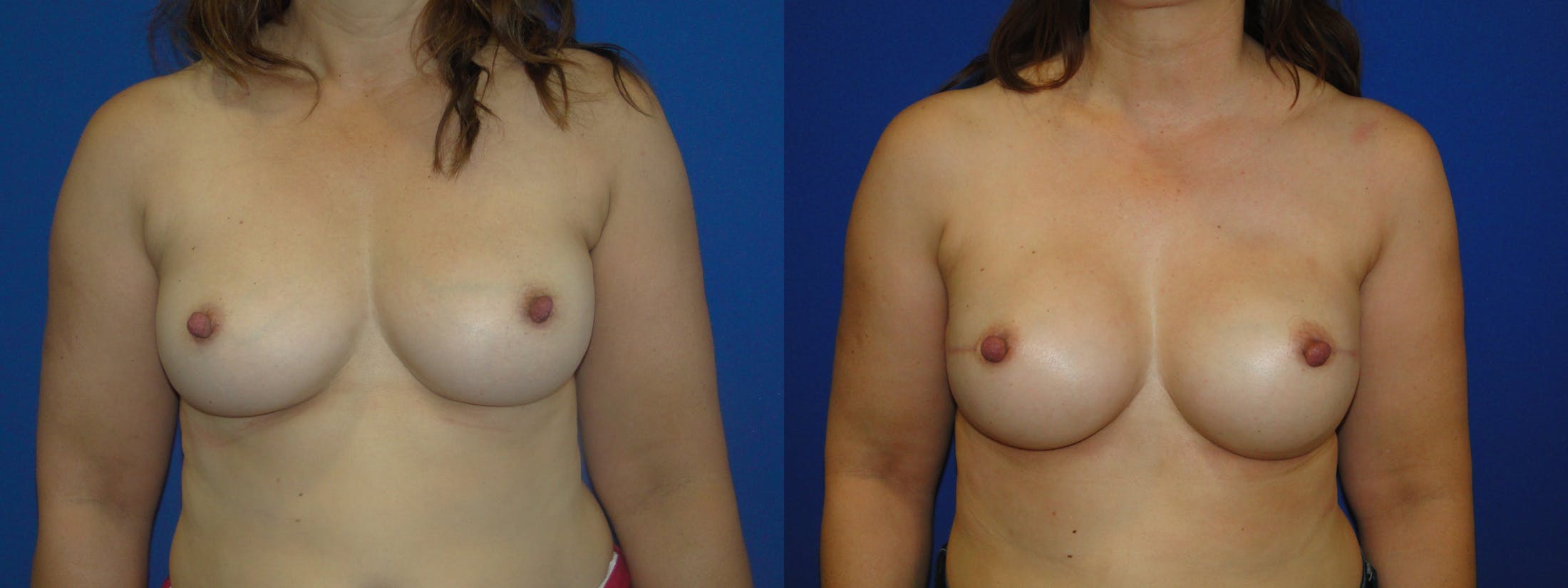 Breast Reconstruction Before & After Gallery - Patient 74857628 - Image 1