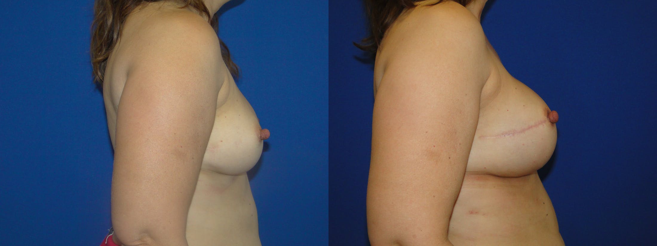 Breast Reconstruction Before & After Gallery - Patient 74857628 - Image 2