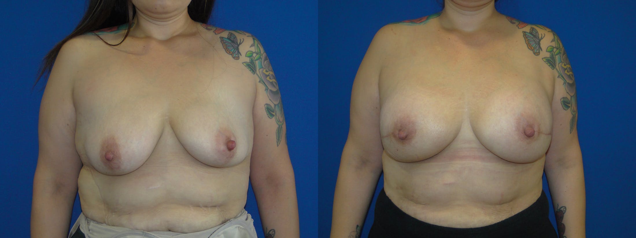 Breast Reconstruction Before & After Gallery - Patient 74857630 - Image 1