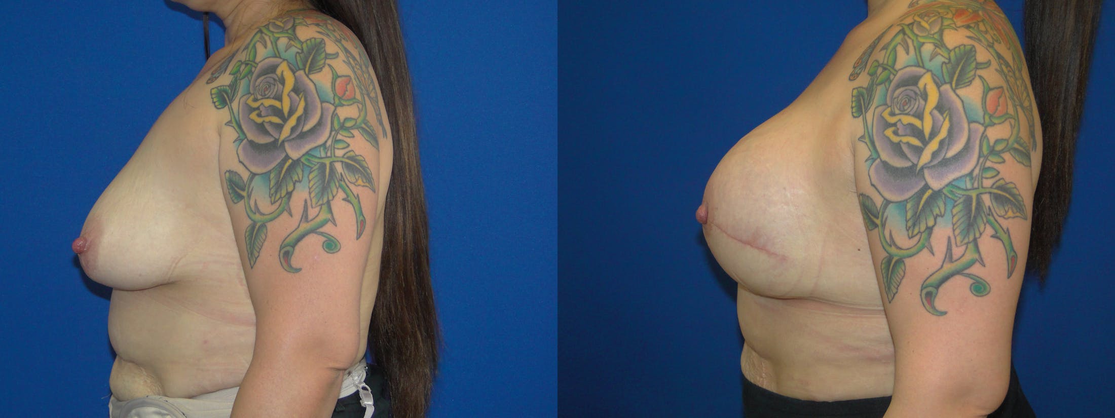 Breast Reconstruction Before & After Gallery - Patient 74857630 - Image 2