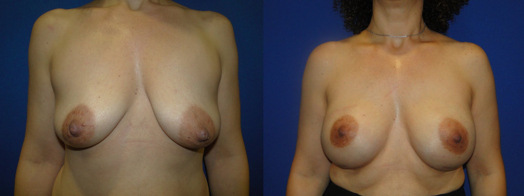 Breast Reconstruction Before & After Gallery - Patient 74861863 - Image 1
