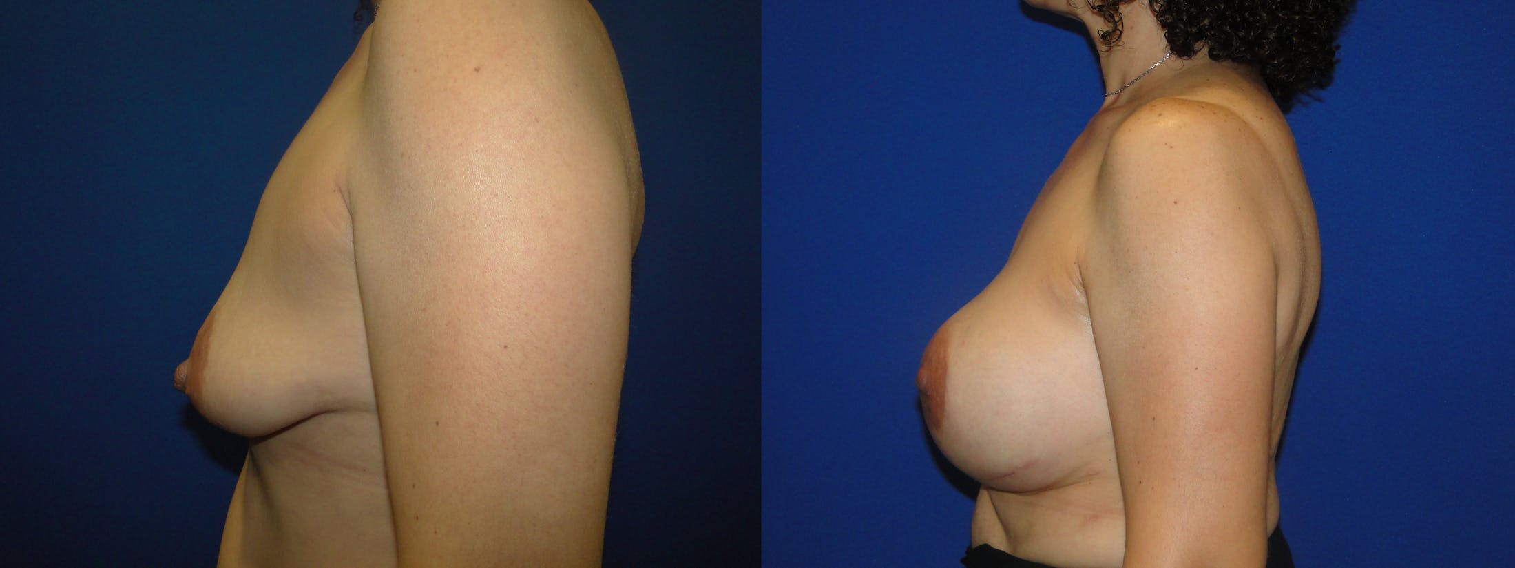 Breast Reconstruction Before & After Gallery - Patient 74861863 - Image 2