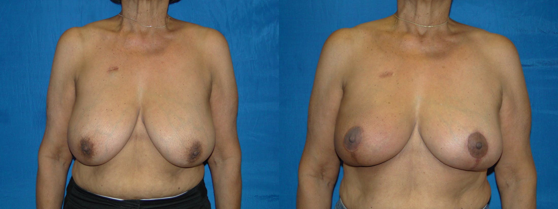 Breast Reconstruction Before & After Gallery - Patient 74861870 - Image 1