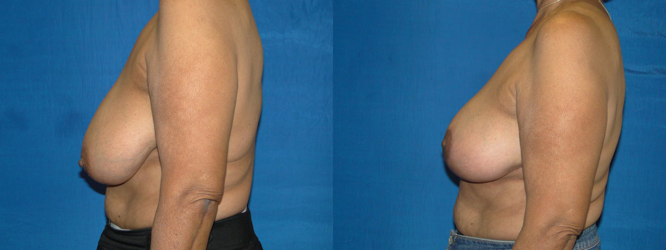 Breast Reconstruction Before & After Gallery - Patient 74861870 - Image 2