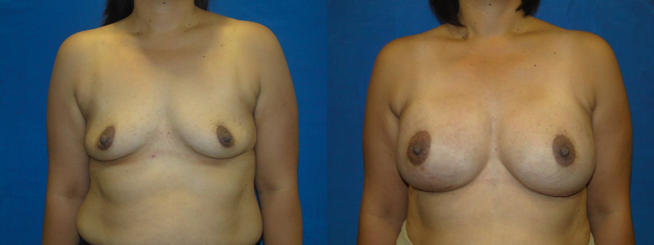 Breast Reconstruction Gallery - Patient 74861872 - Image 1