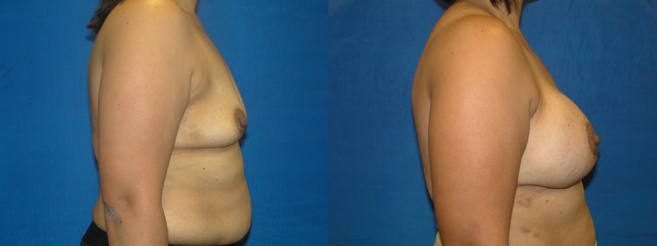 Breast Reconstruction Before & After Gallery - Patient 74861872 - Image 2