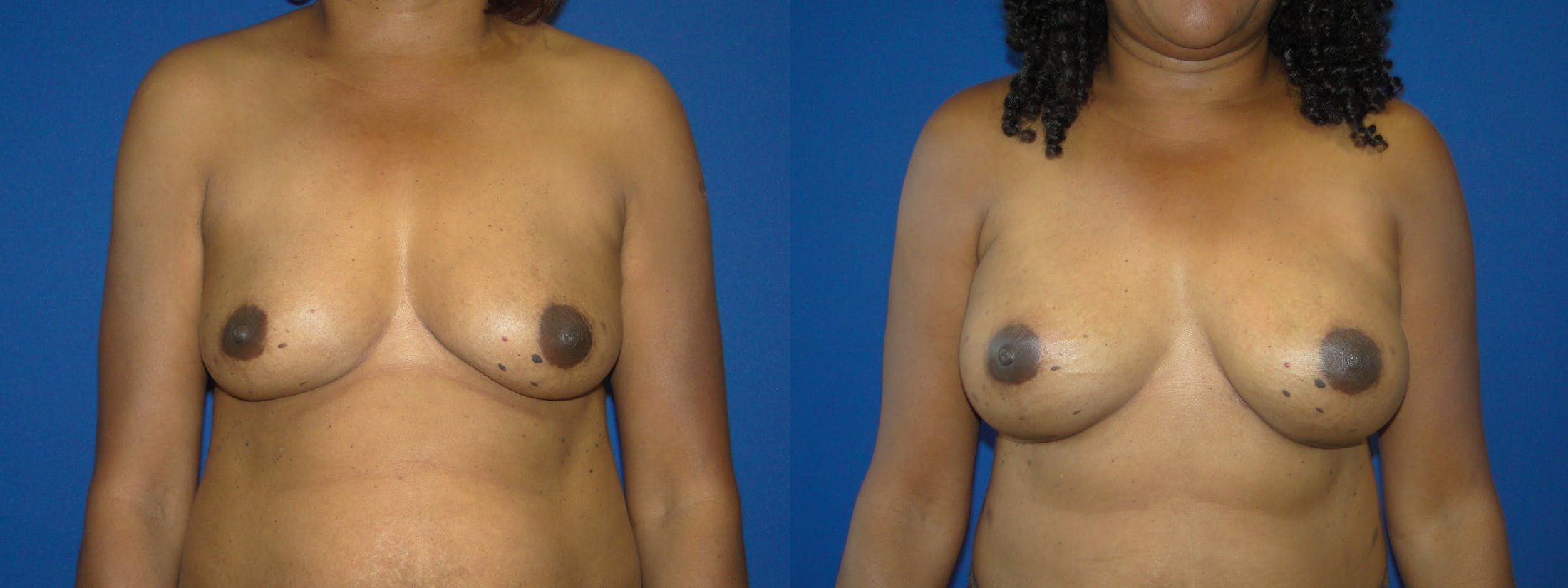 Breast Reconstruction Gallery - Patient 74861876 - Image 1