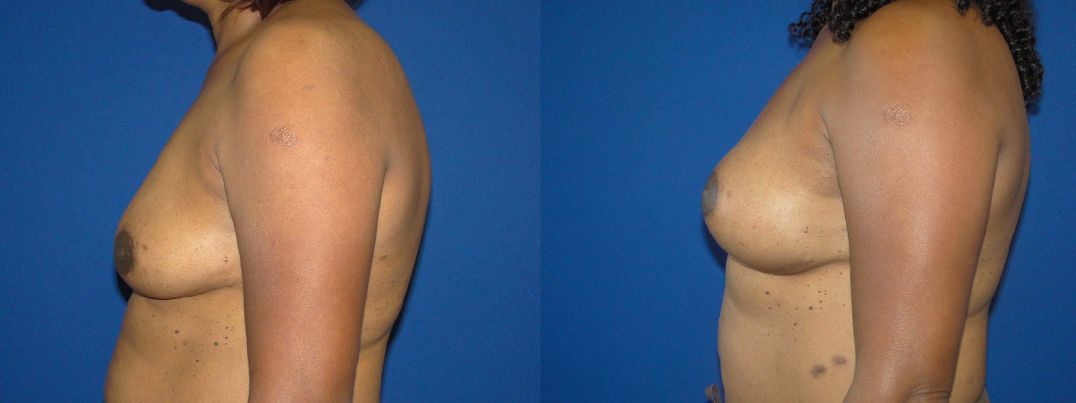 Breast Reconstruction Before & After Gallery - Patient 74861876 - Image 2