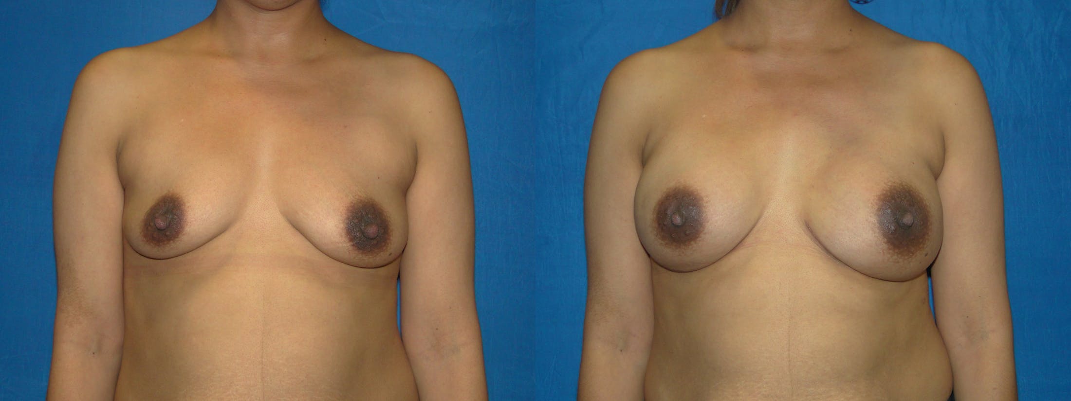Breast Reconstruction Before & After Gallery - Patient 74861879 - Image 1