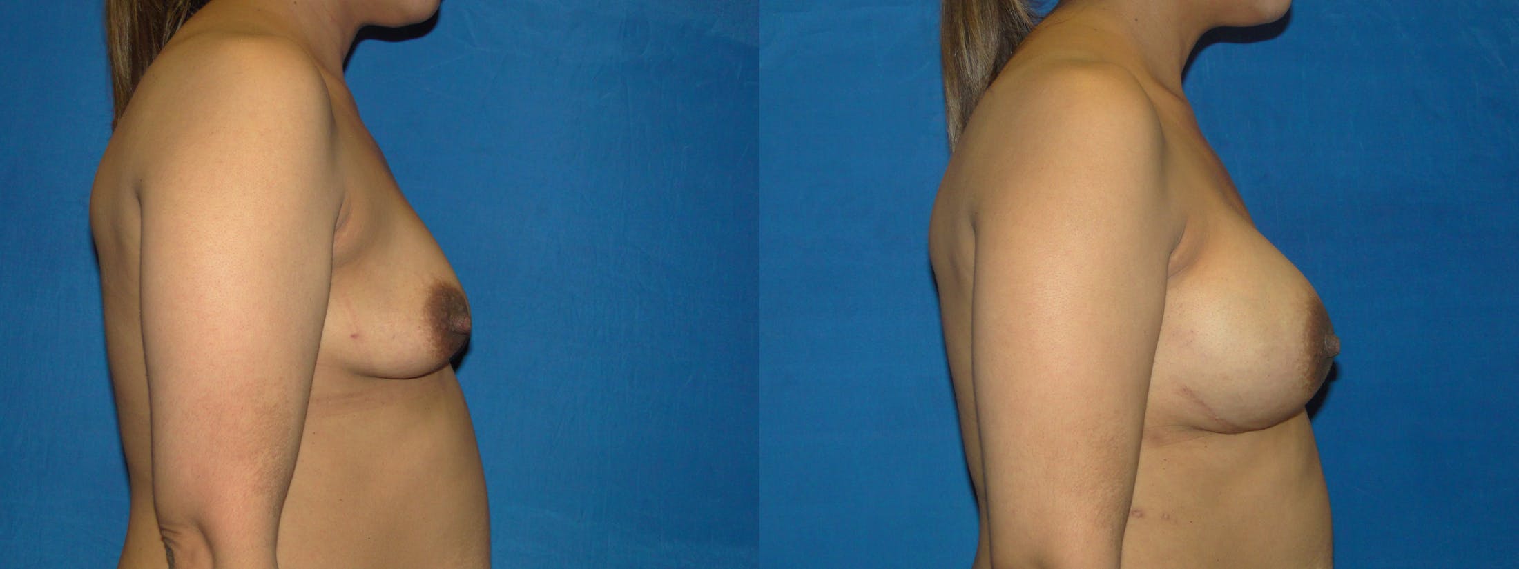 Breast Reconstruction Before & After Gallery - Patient 74861879 - Image 2