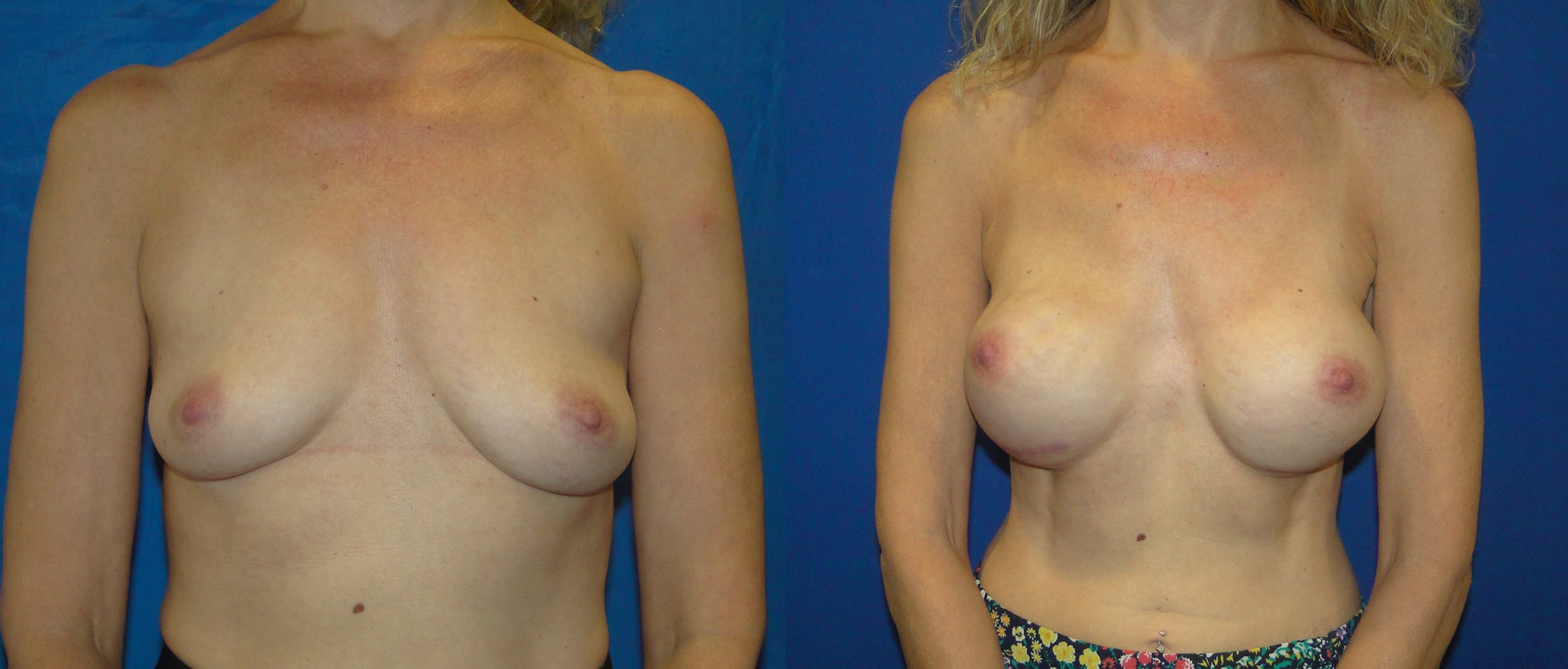 Breast Reconstruction Gallery - Patient 74861890 - Image 1