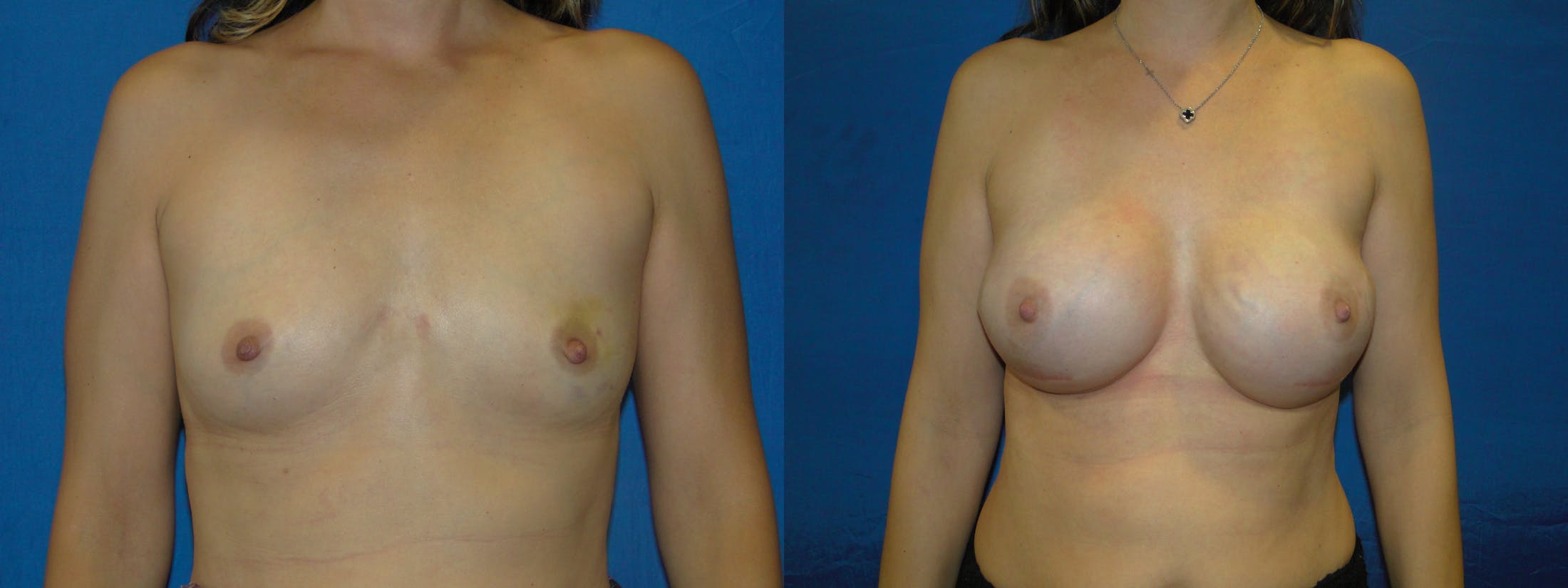 Breast Reconstruction Before & After Gallery - Patient 74861894 - Image 1