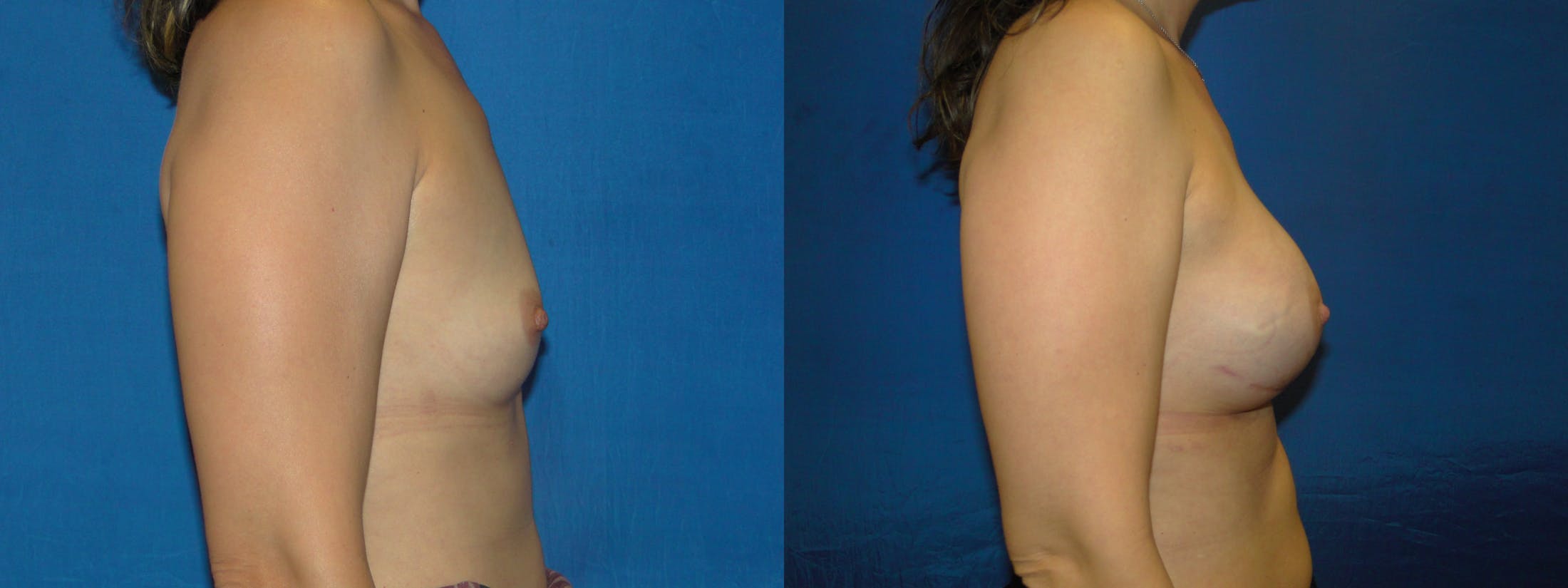 Breast Reconstruction Before & After Gallery - Patient 74861894 - Image 2