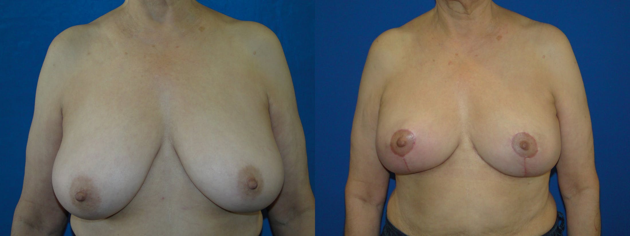 Breast Reconstruction Before & After Gallery - Patient 74861897 - Image 1