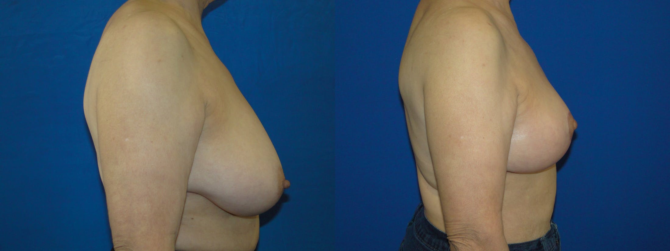 Breast Reconstruction Before & After Gallery - Patient 74861897 - Image 2