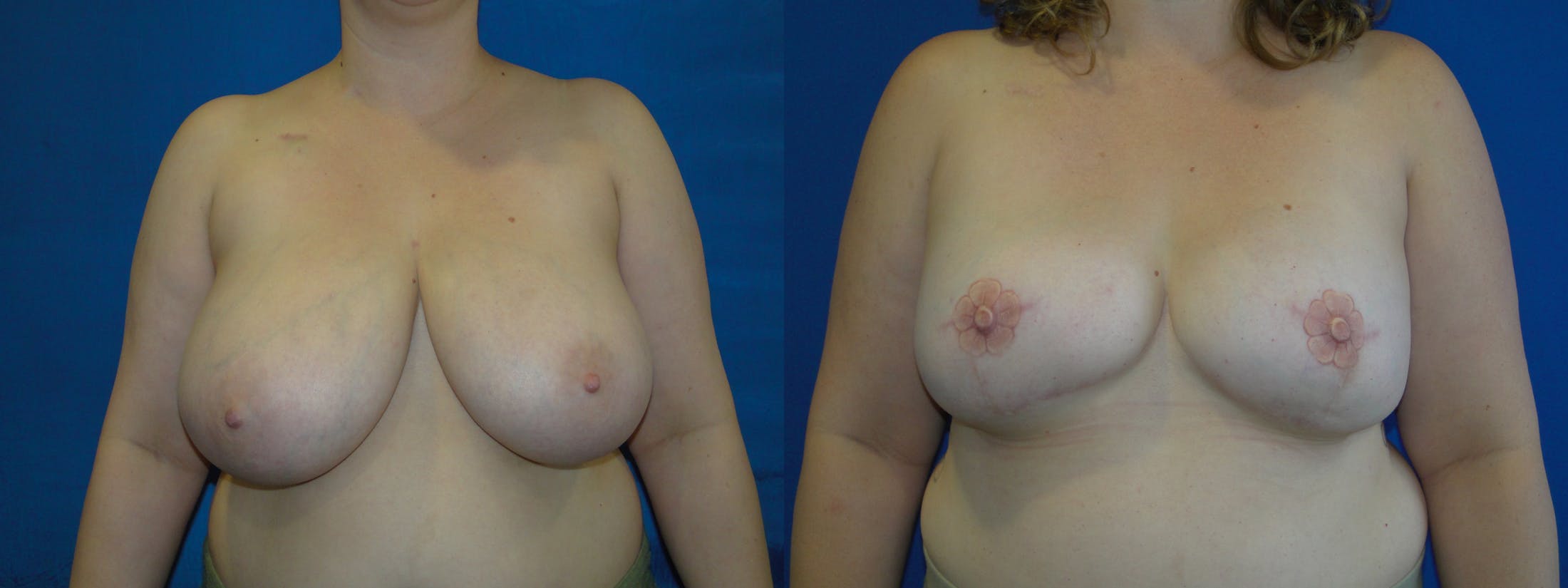 Breast Reconstruction Before & After Gallery - Patient 74861901 - Image 1