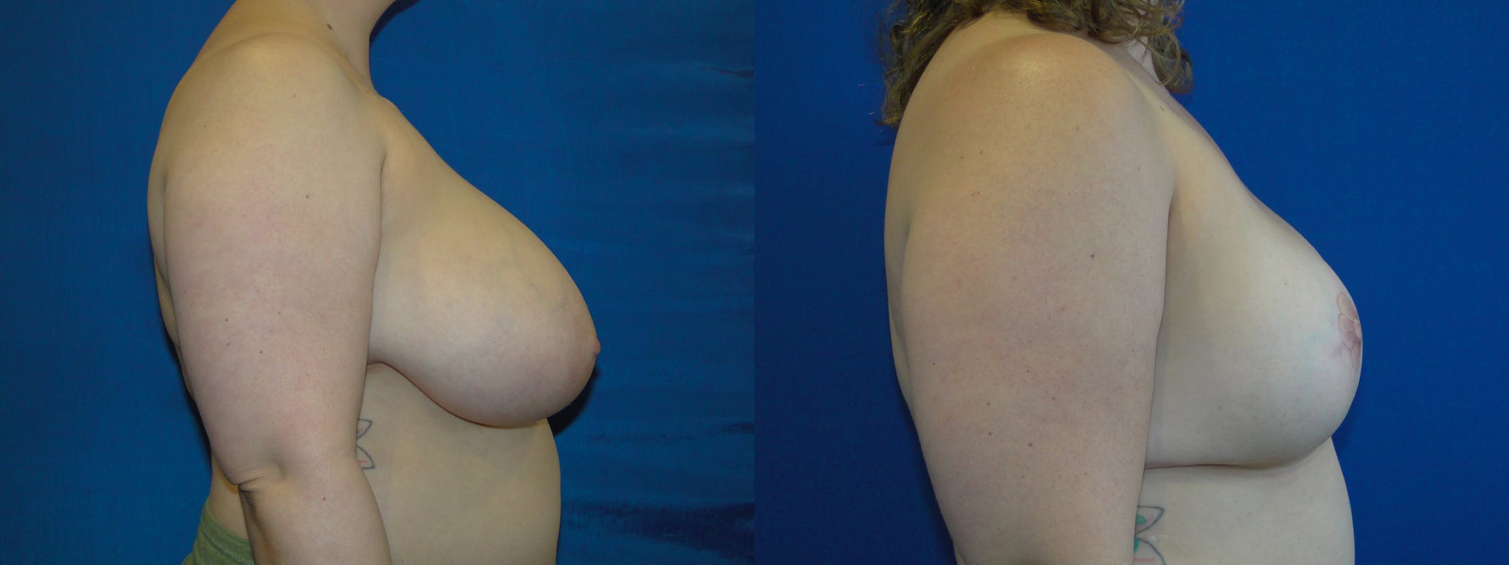 Breast Reconstruction Before & After Gallery - Patient 74861901 - Image 2