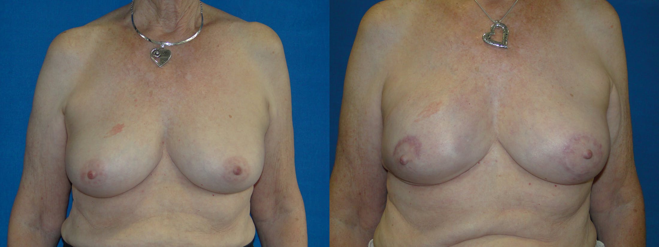 Breast Reconstruction Before & After Gallery - Patient 74861913 - Image 1