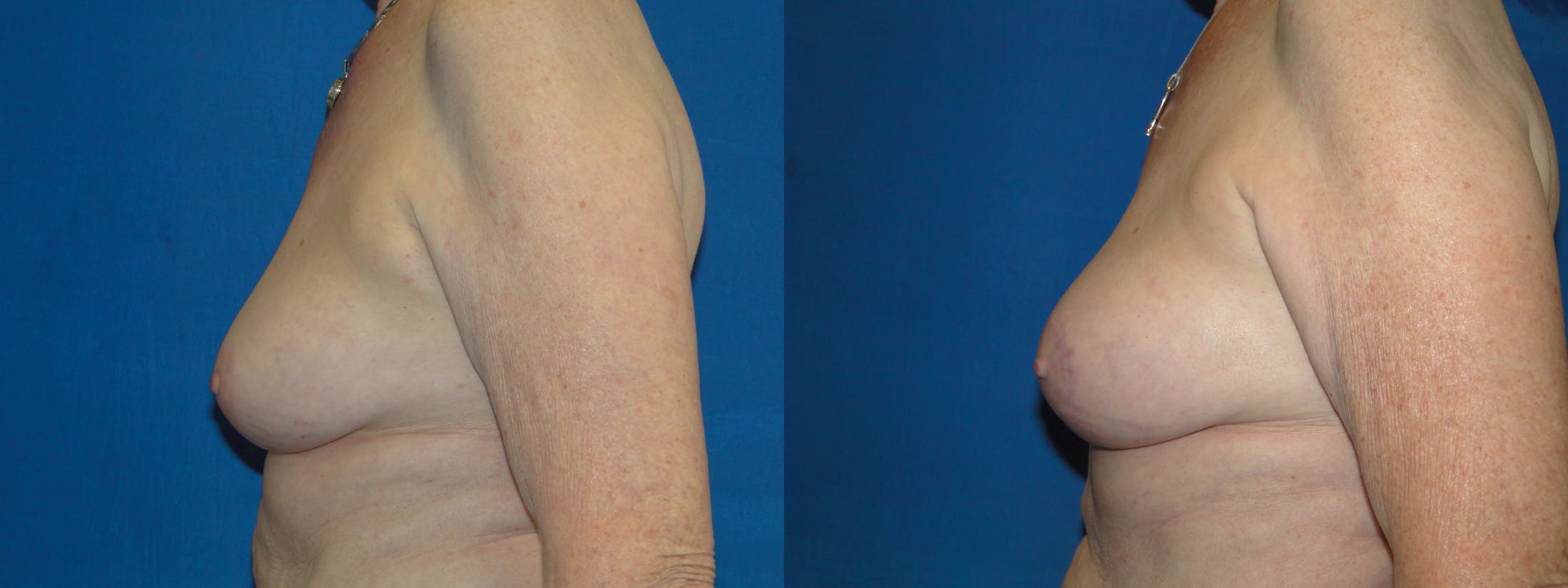 Breast Reconstruction Before & After Gallery - Patient 74861913 - Image 2