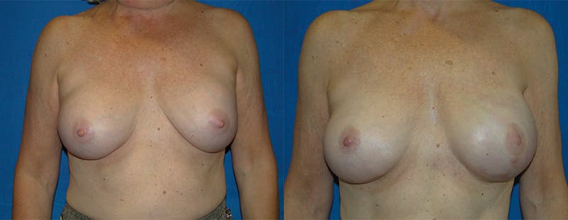 Breast Reconstruction Gallery - Patient 74861914 - Image 1