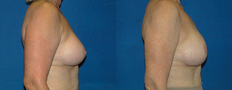 Breast Reconstruction Gallery - Patient 74861914 - Image 2