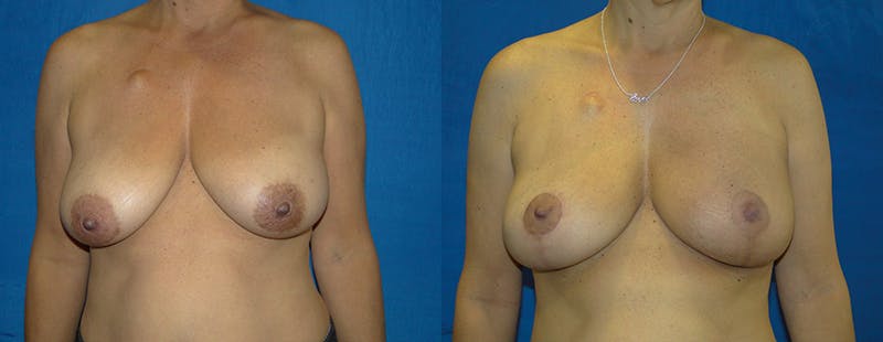 Breast Reconstruction Before & After Gallery - Patient 74861915 - Image 1