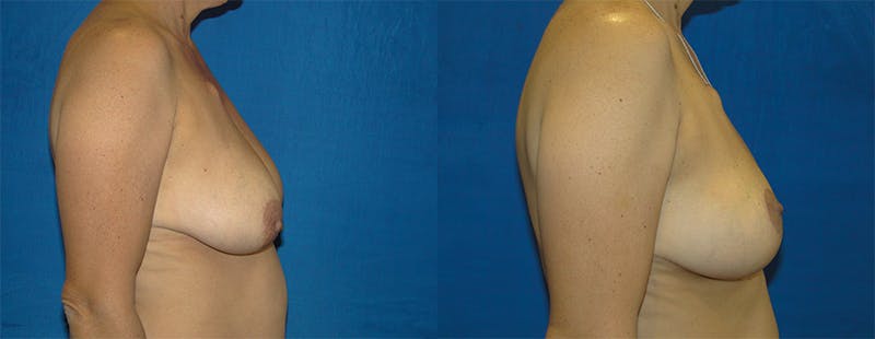 Breast Reconstruction Before & After Gallery - Patient 74861915 - Image 2