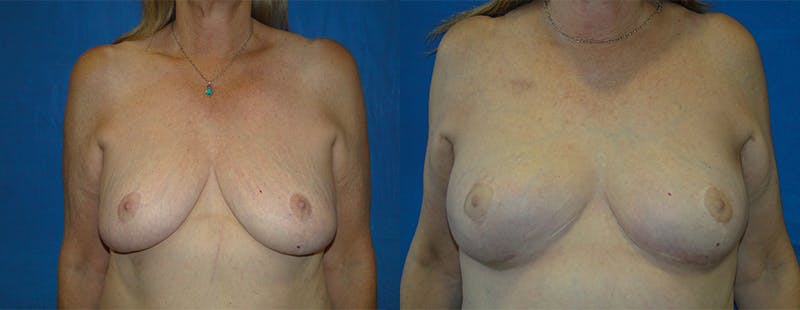 Breast Reconstruction Before & After Gallery - Patient 74861919 - Image 1