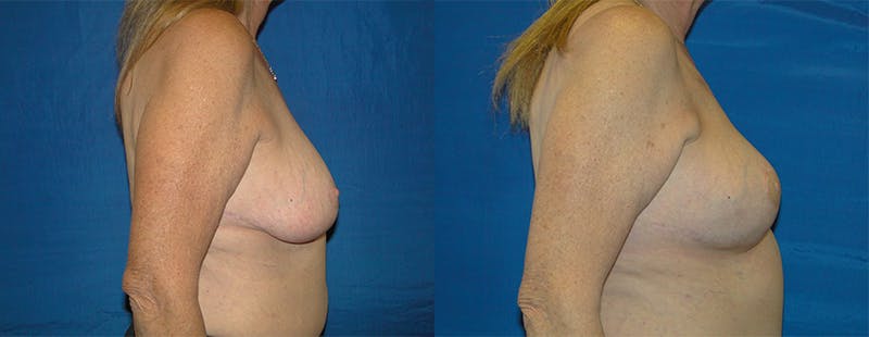 Breast Reconstruction Before & After Gallery - Patient 74861919 - Image 2