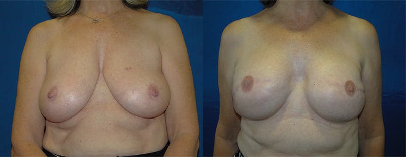 Breast Reconstruction Before & After Gallery - Patient 74861920 - Image 1