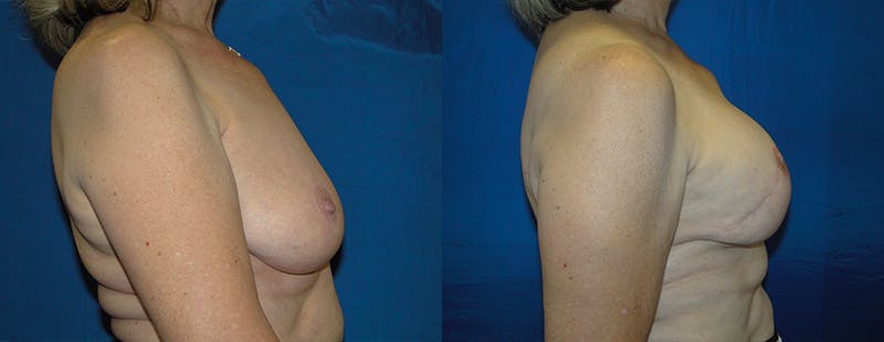 Breast Reconstruction Before & After Gallery - Patient 74861920 - Image 2