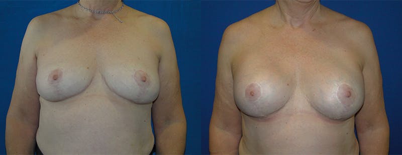Breast Reconstruction Before & After Gallery - Patient 74861921 - Image 1