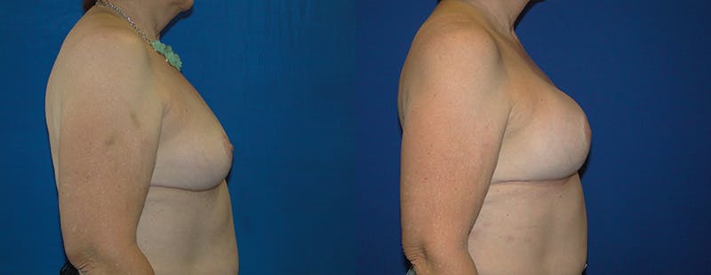 Breast Reconstruction Before & After Gallery - Patient 74861921 - Image 2
