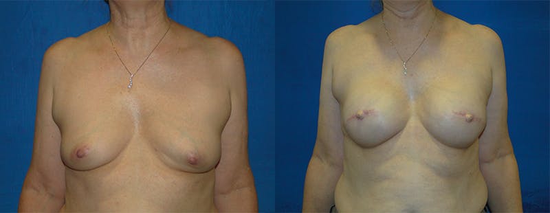 Breast Reconstruction Before & After Gallery - Patient 74861922 - Image 1