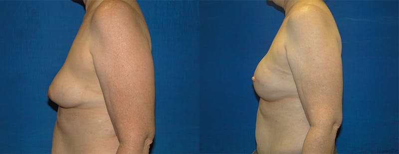 Breast Reconstruction Before & After Gallery - Patient 74861922 - Image 2