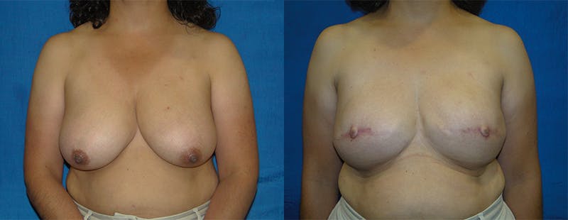 Breast Reconstruction Before & After Gallery - Patient 74861923 - Image 1