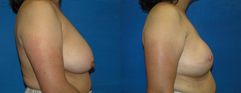 Breast Reconstruction Before & After Gallery - Patient 74861923 - Image 2
