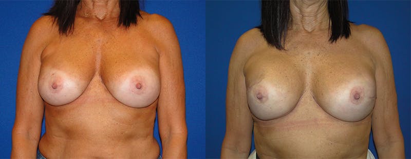 Breast Reconstruction Before & After Gallery - Patient 74861924 - Image 1